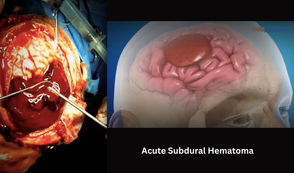 Acute Subdural Hematoma